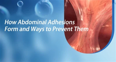 Hvordan abdominale adhesjoner dannes og måter å forhindre dem på